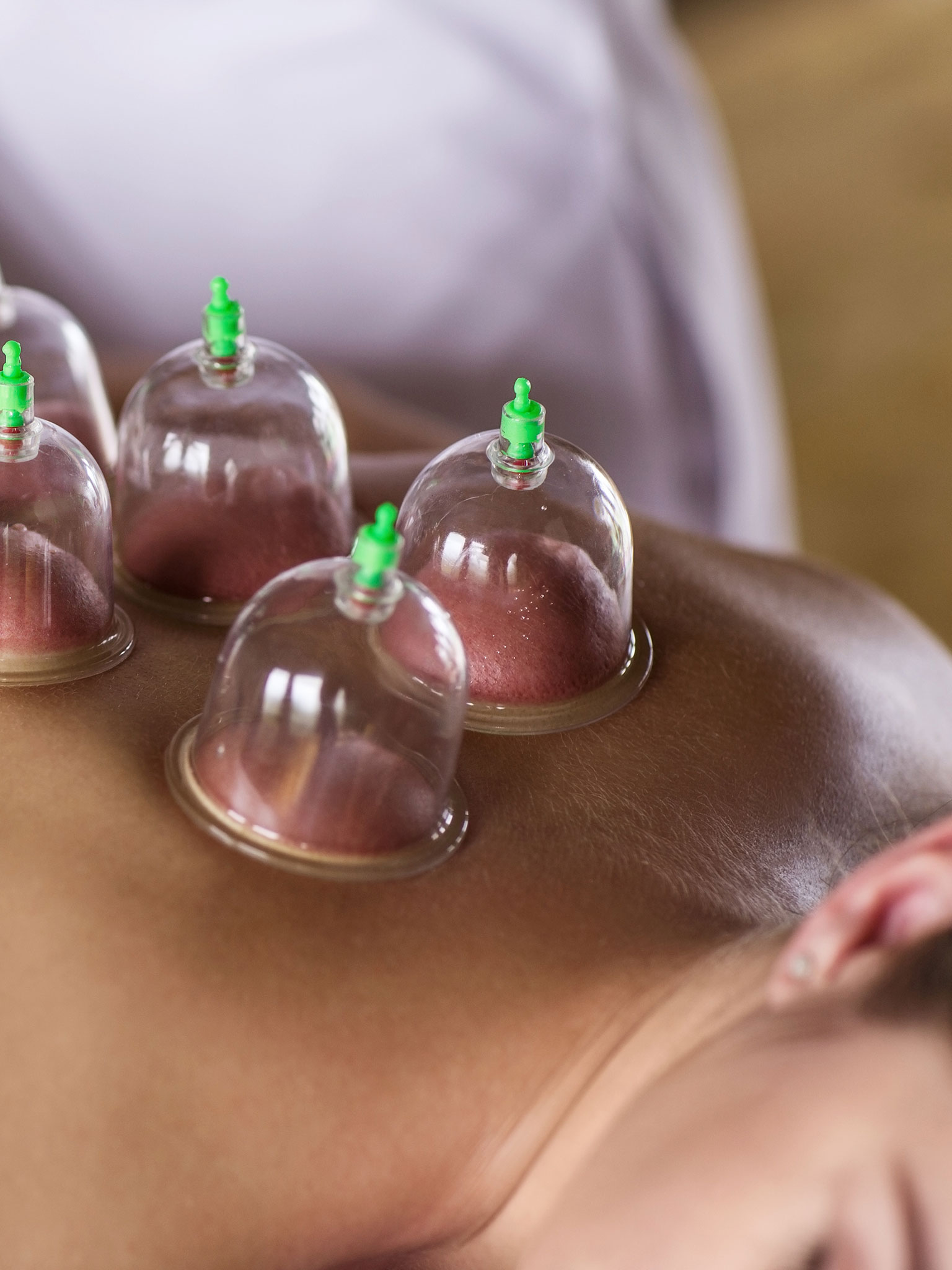 Cupping Treatment Paisley