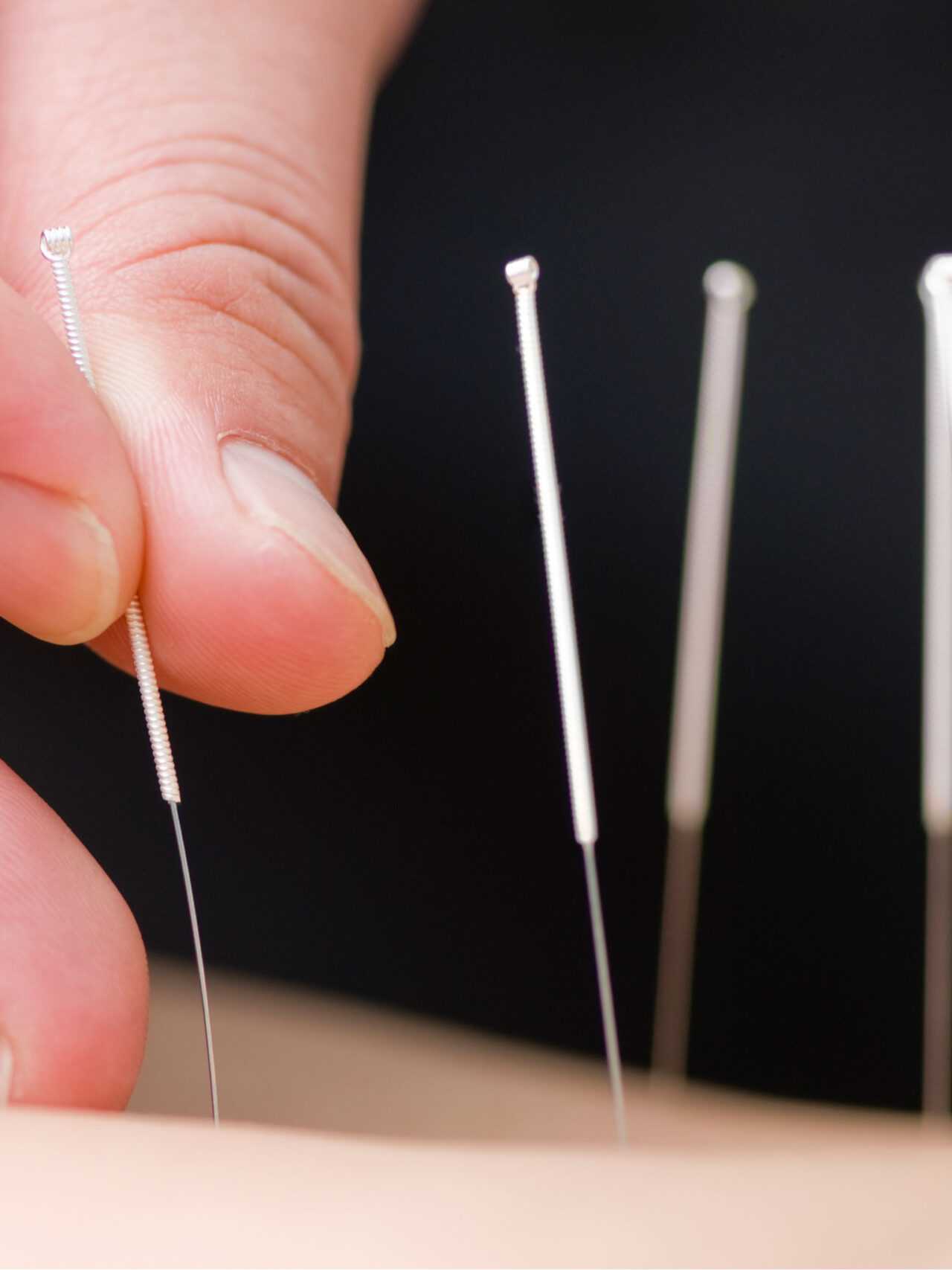 Acupuncture & Dry Needling Spphysiotherapy
