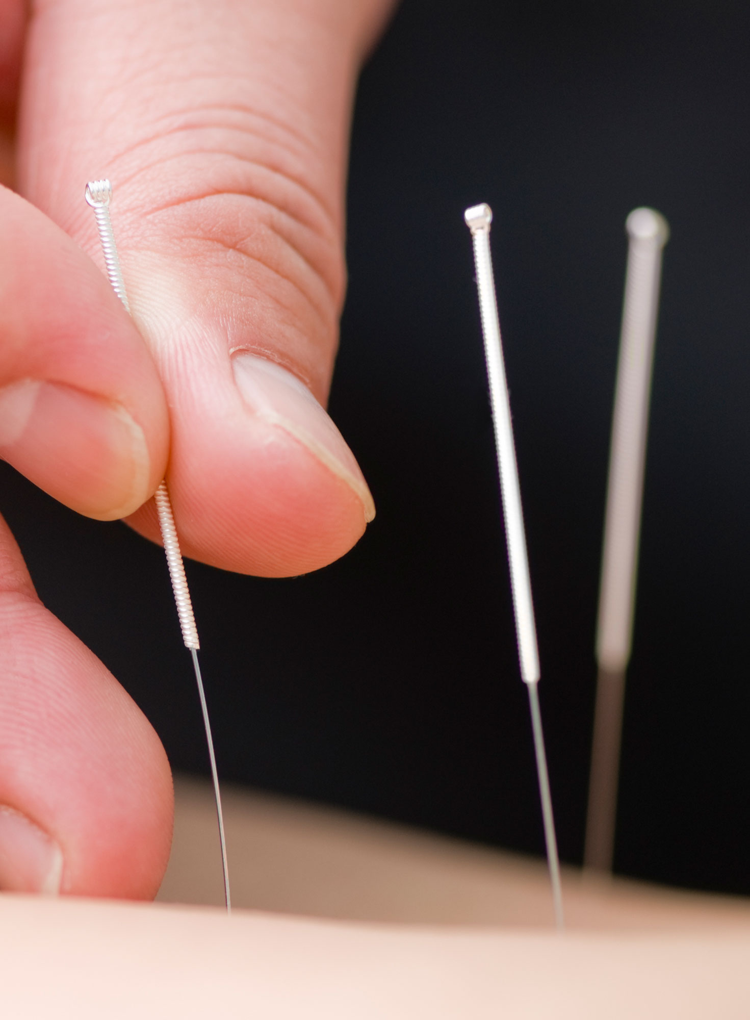 acupuncture treatment Paisley