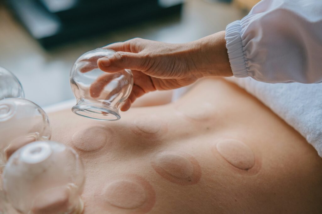 cupping glasgow | cupping renfrewshire view 1